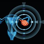 New Analysis Sheds Light on Link Between Ovulation and Ovarian Cancer