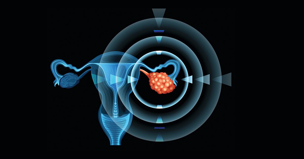 Nowa analiza podkreśla związek między owulacją a rakiem jajnika