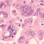 Chemotherapy-Resistant Ovarian Cancer Cells Protect Their Neighbors