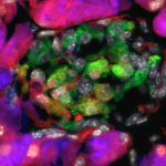 Repurposed Cancer Drug Could Treat Diabetes by Nudging Pancreatic Acinar Cells to Produce Insulin