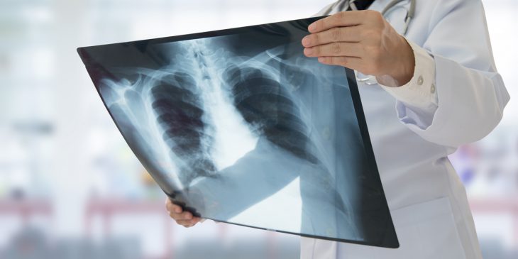 Experts Tackle Aspiration in Lung Transplant Patients