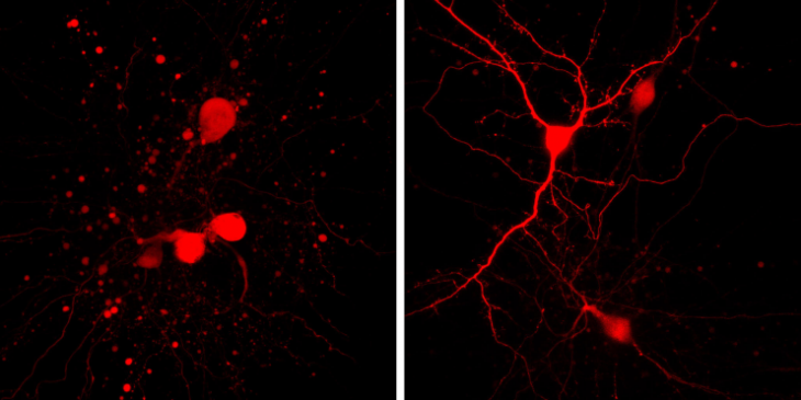 Researchers One Step Closer to Preventing Post-Stroke Brain Cell Death