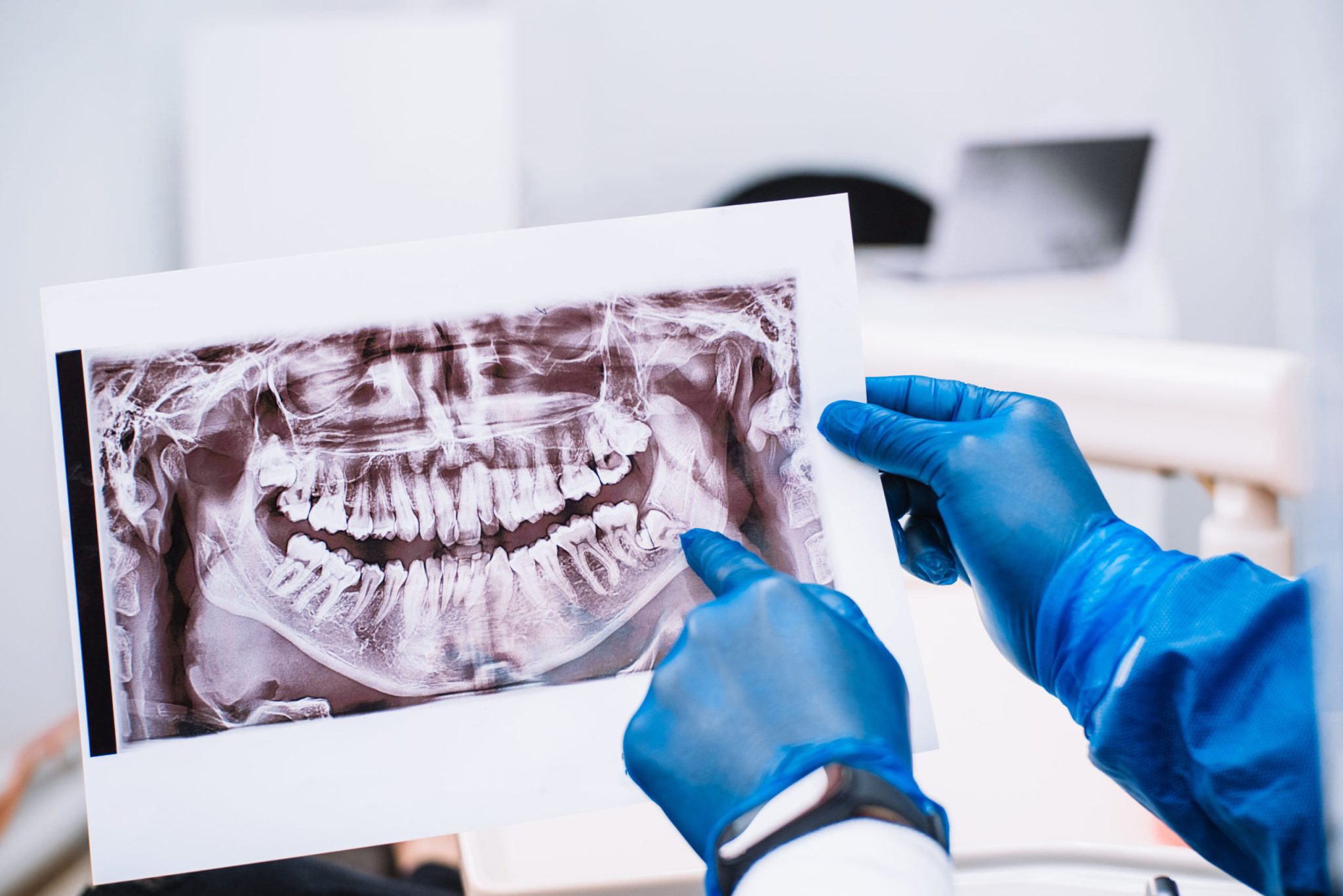 Dentist examining a dental panoramic radiograph showing wisdom teeth