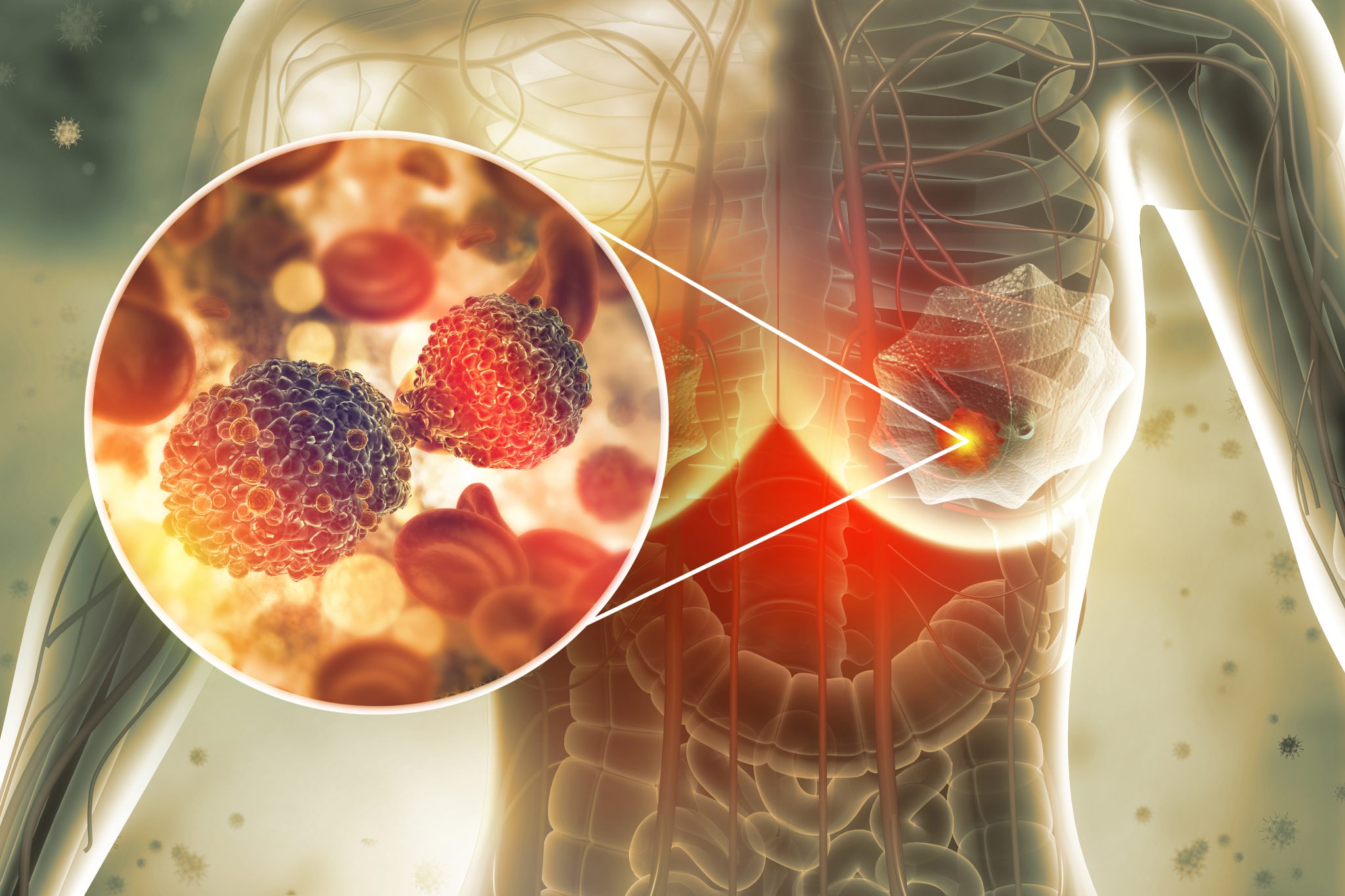 When Tumors Collide: Analysis of Mixed-Type Breast Cancer Reveals  Complexity - UPMC & Pitt Health Sciences News Blog