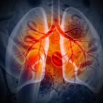 Medical Illustration showing lung cancer or bronchial carcinoma on medical background, 3d illustration