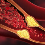 UPMC First in Central Pa. to Treat Severe Peripheral Artery Disease with New Minimally Invasive Treatment Vascular constriction in artery